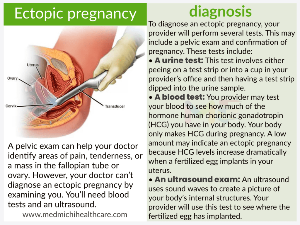 Ectopic pregnancy 