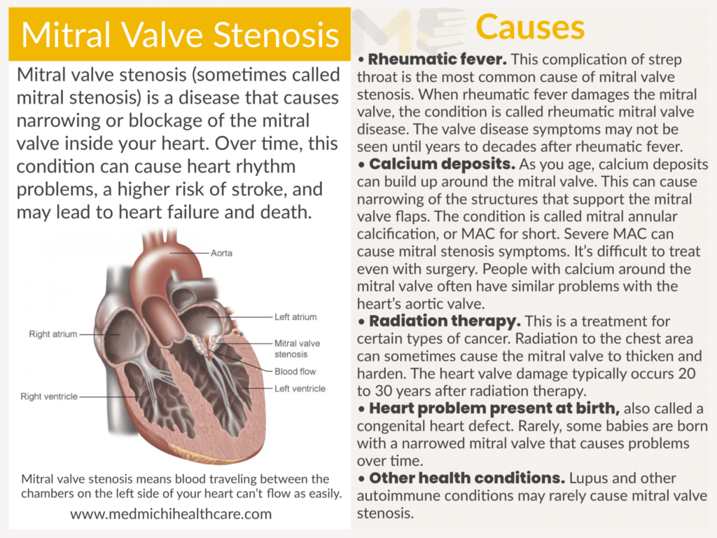 Mitral valve stenosis​