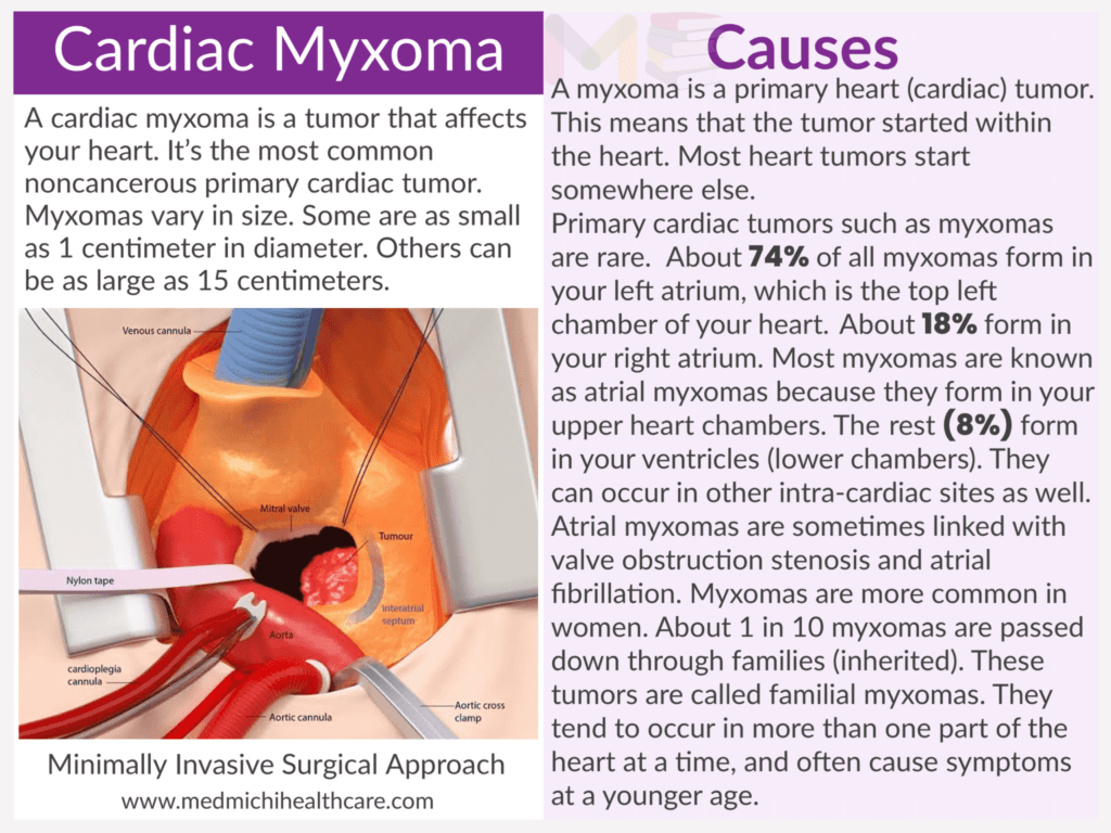 Cardiac myxoma​