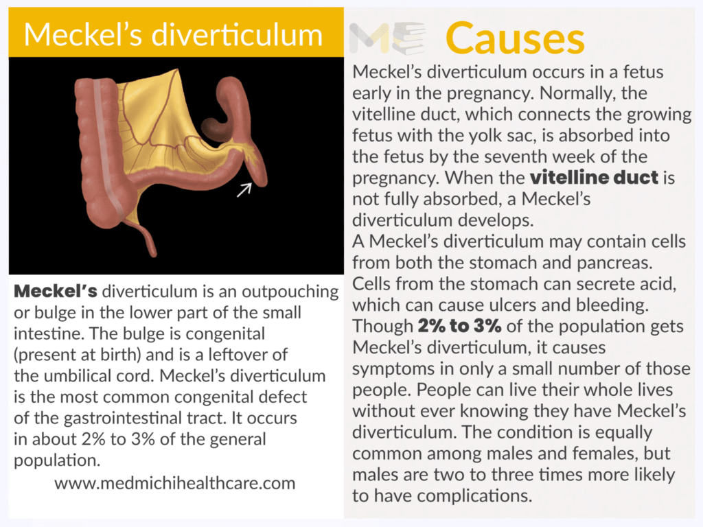 Meckel’s diverticulum ​