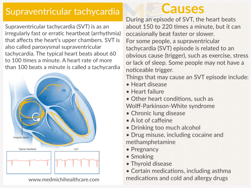 Supraventricular tachycardia​