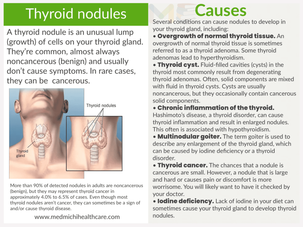 Thyroid nodules​
