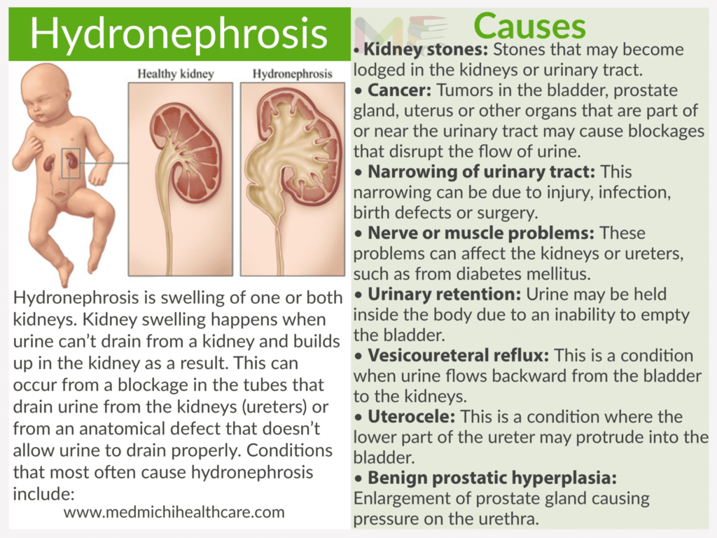 Hydronephrosis