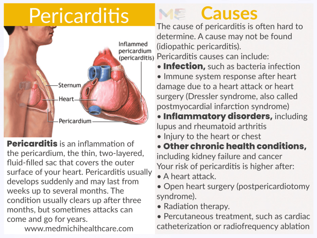 Pericarditis 