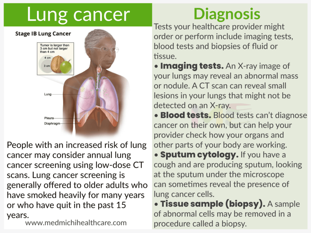 Lung cancer 