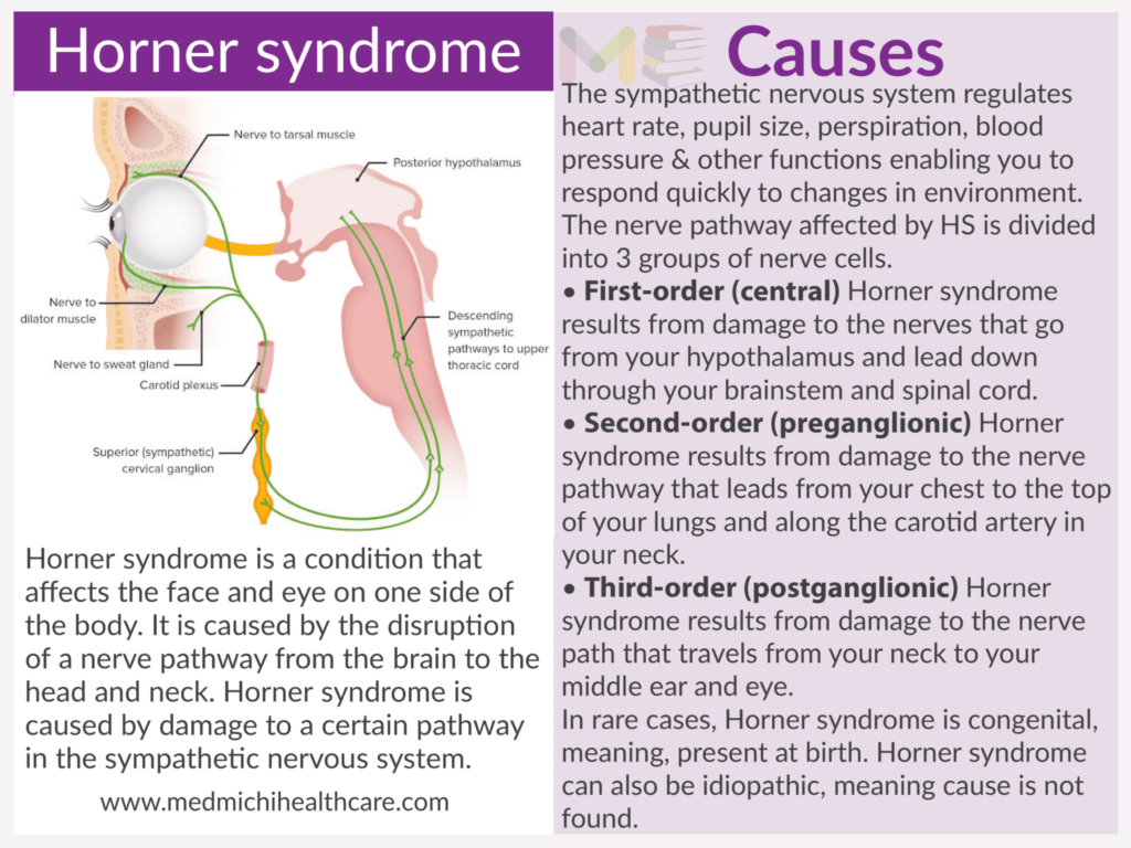 Horner syndrome ​