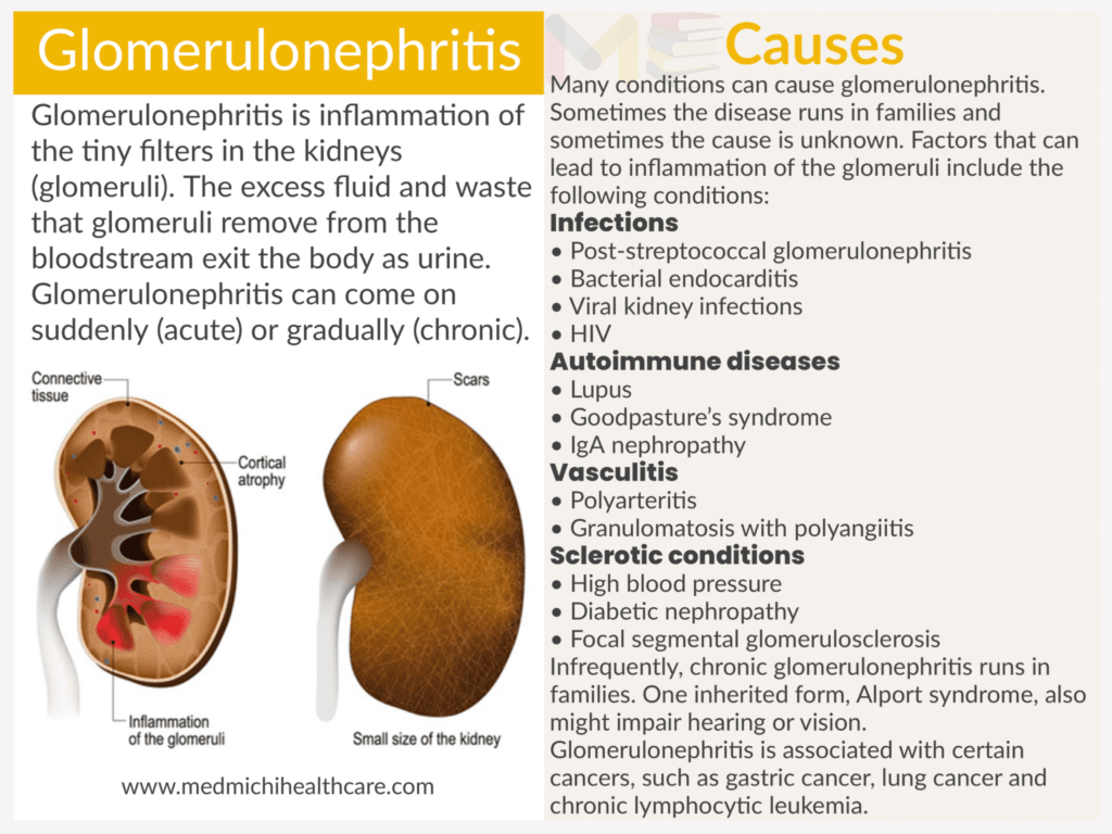 Glomerulonephritis​