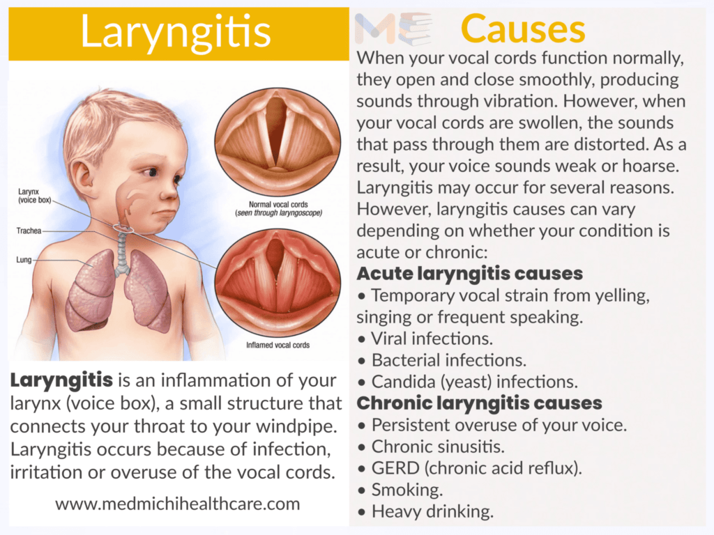 Laryngitis 