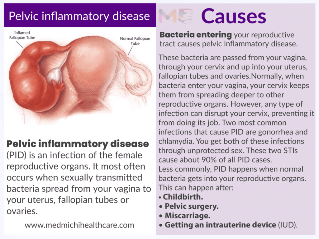 Pelvic inflammatory disease ​