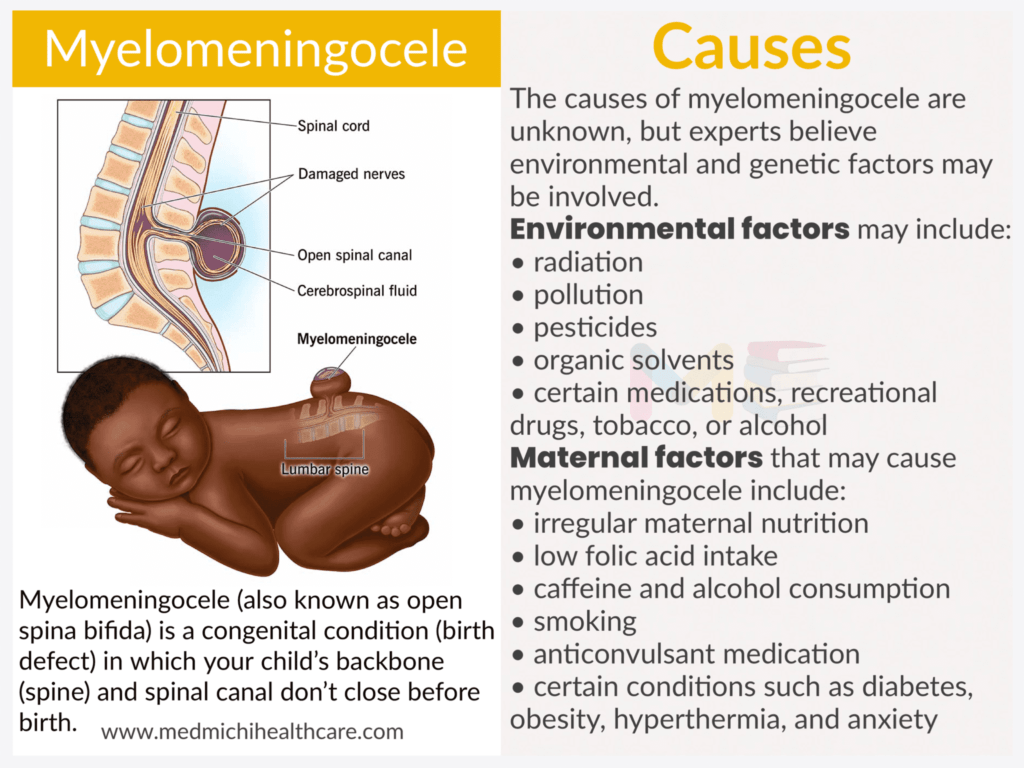 Myelomeningocele