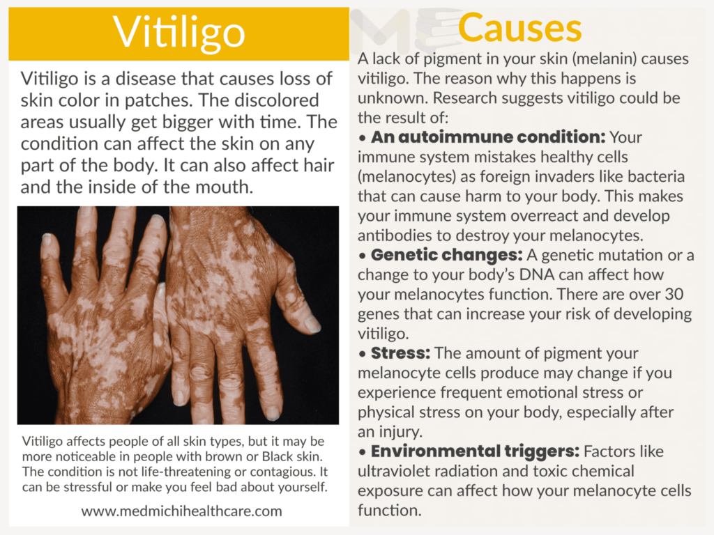 Vitiligo