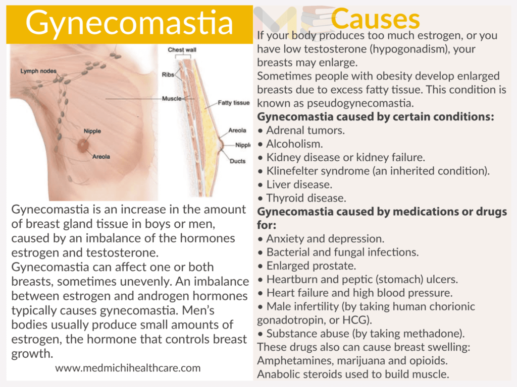 Gynecomastia ​