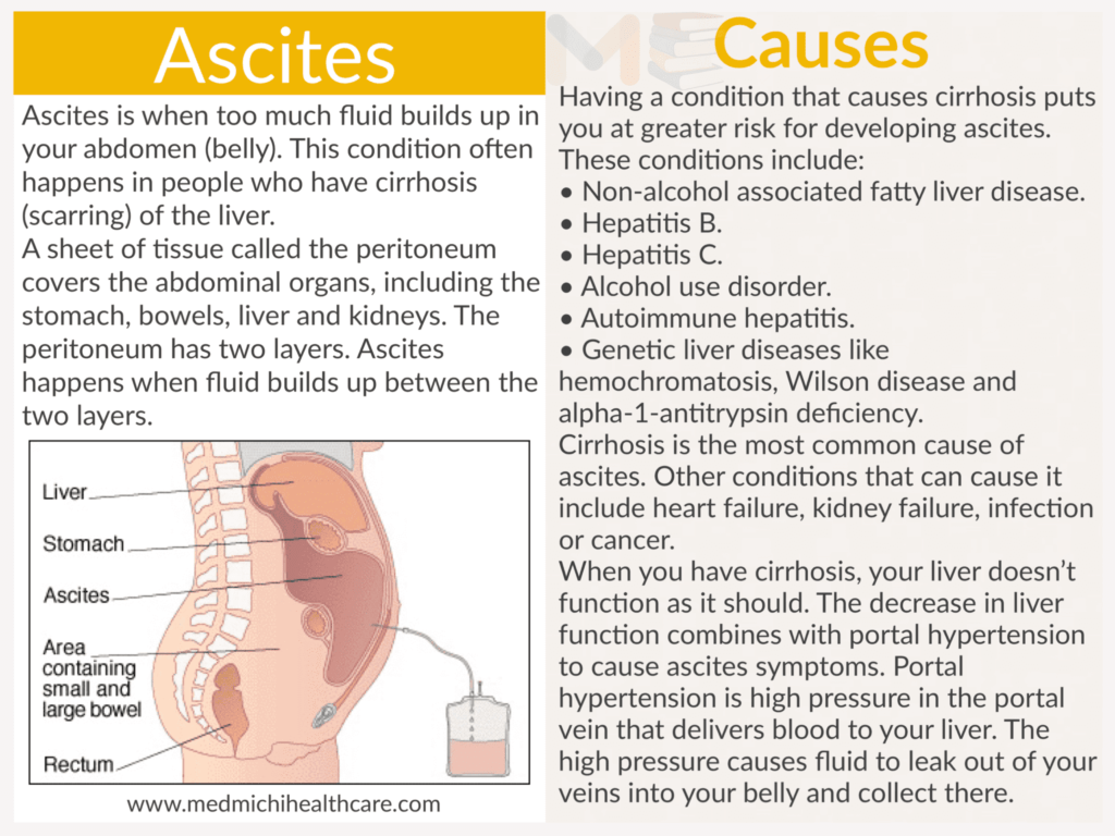 Ascites