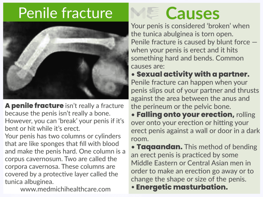 Penile fracture 