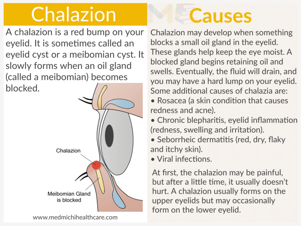 Chalazion