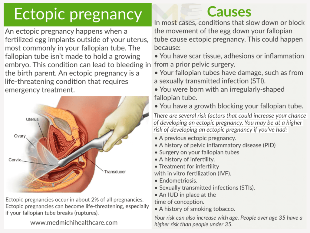 All Disease Causes Short Notes 22 Ectopic pregnancy