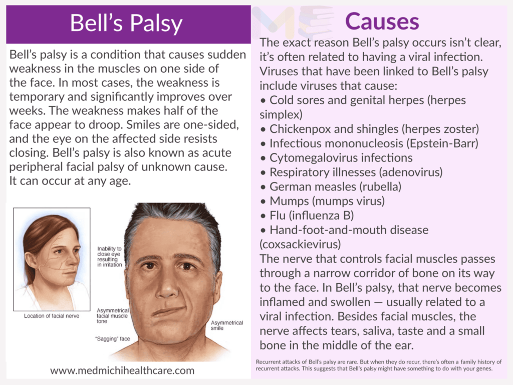 All Disease Causes Short Notes 6 Bell’s palsy