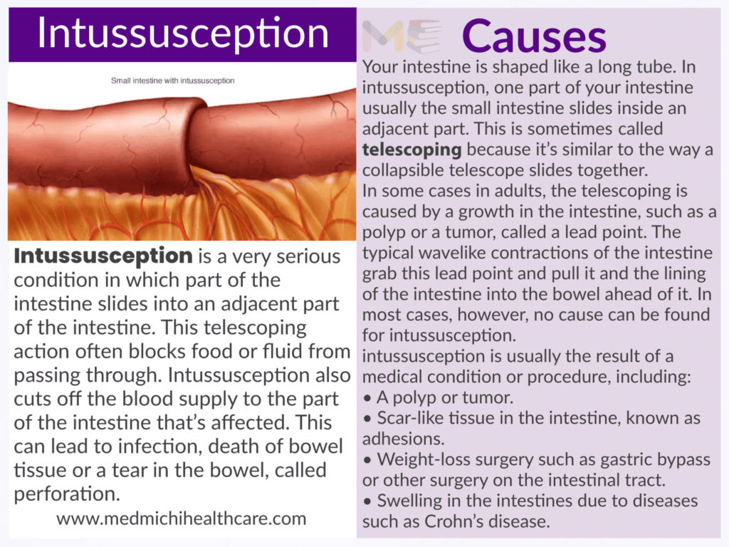 Intussusception 