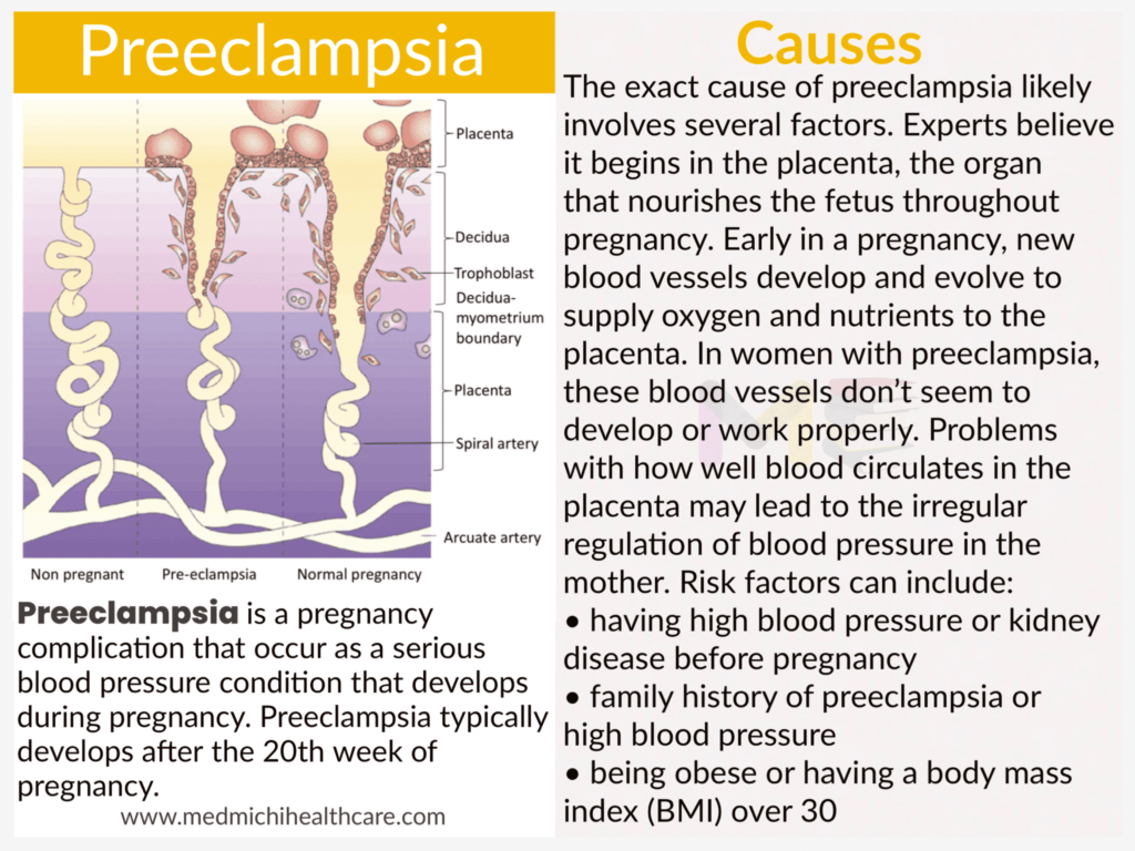 All Disease Causes Short Notes 19 Preeclampsia