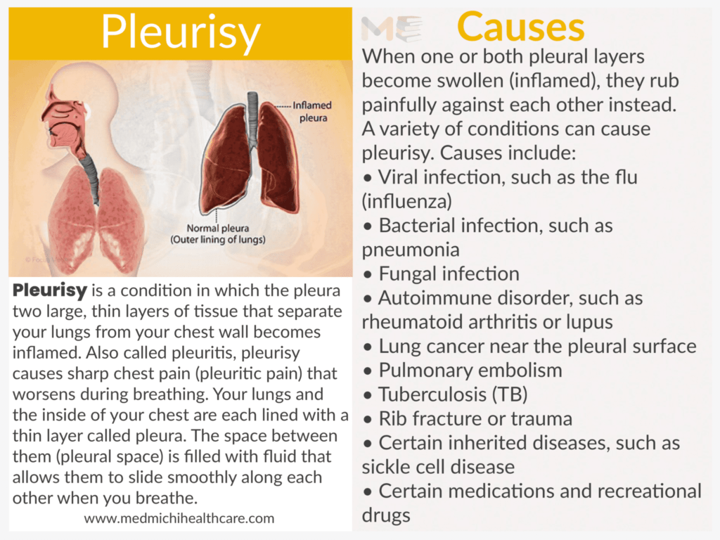 Pleurisy 