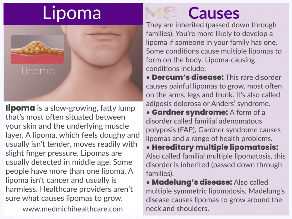 Lipoma 