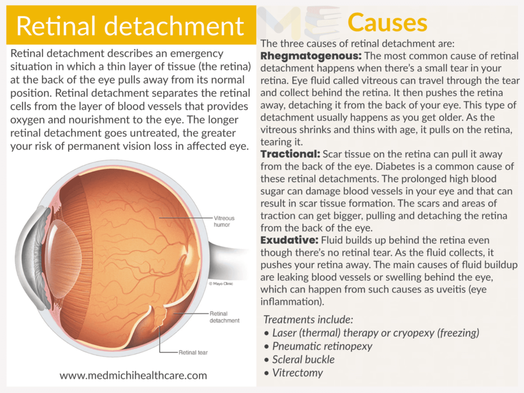 Retinal detachment ​