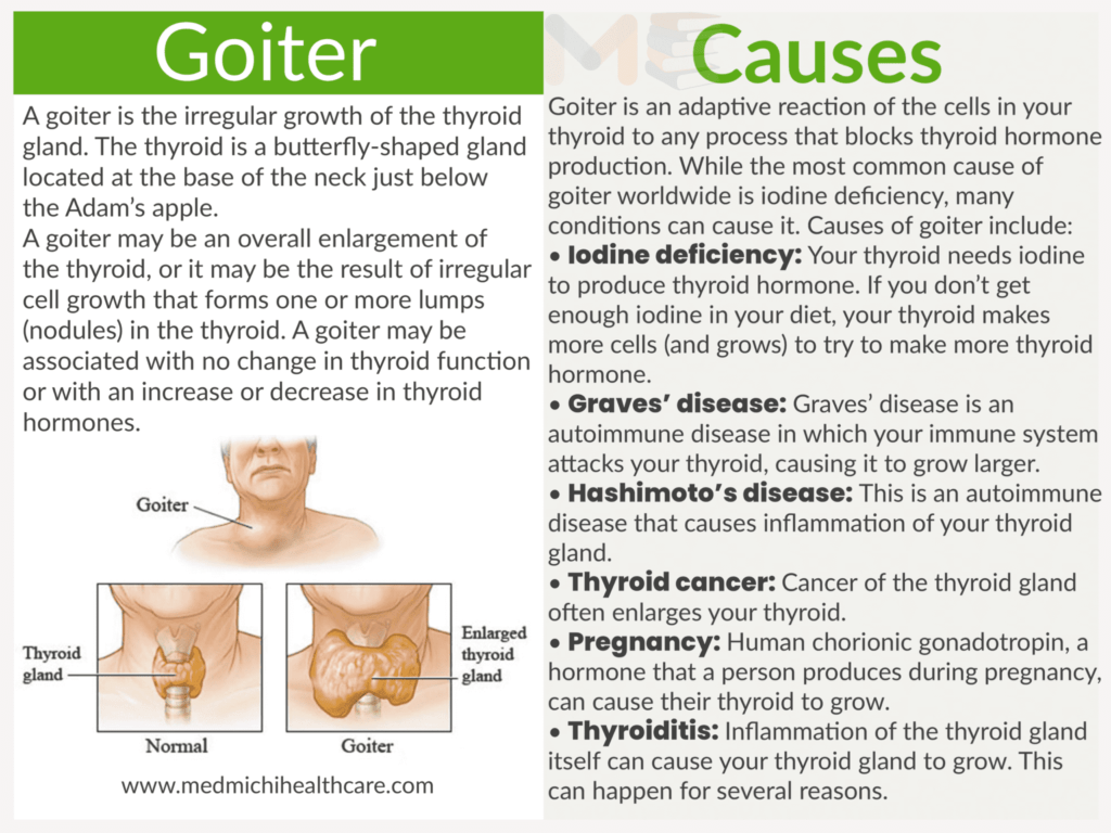 Goiter 