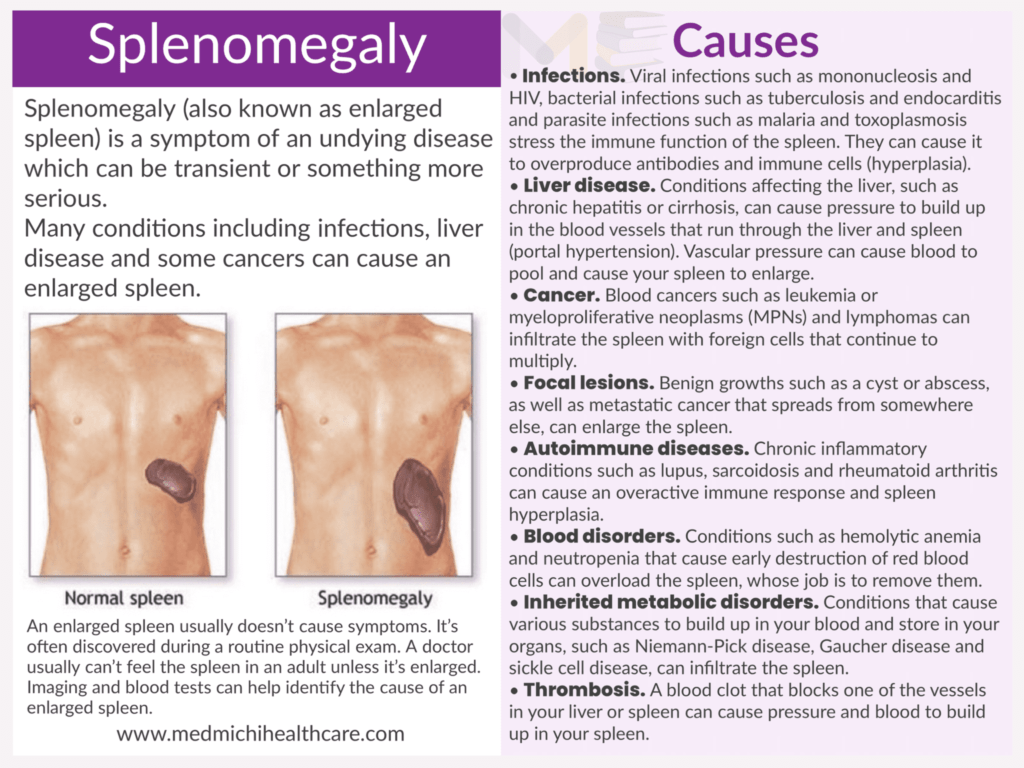 Splenomegaly 