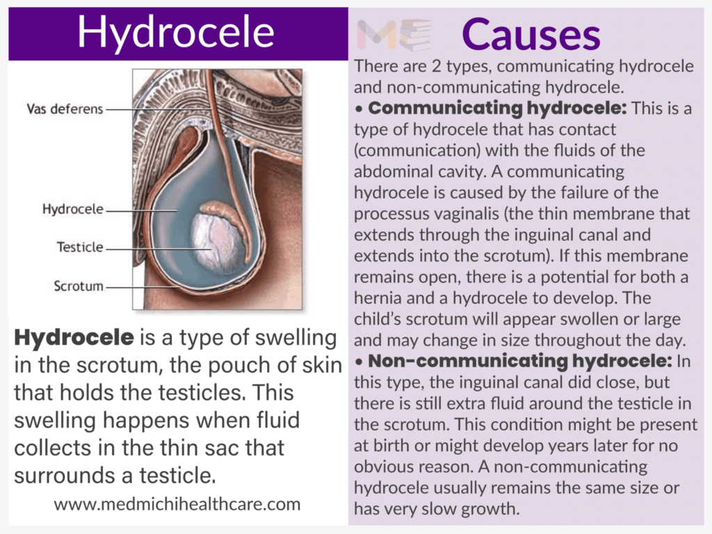 Hydrocele​