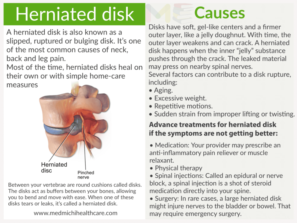Herniated disk​