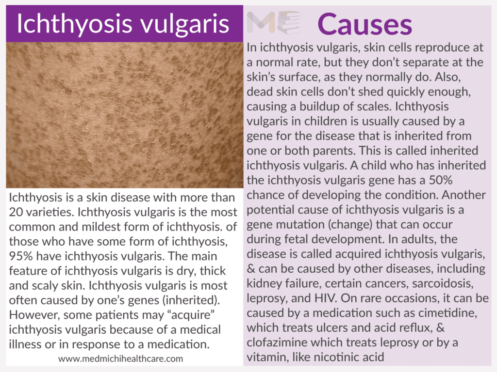 Ichthyosis vulgaris ​