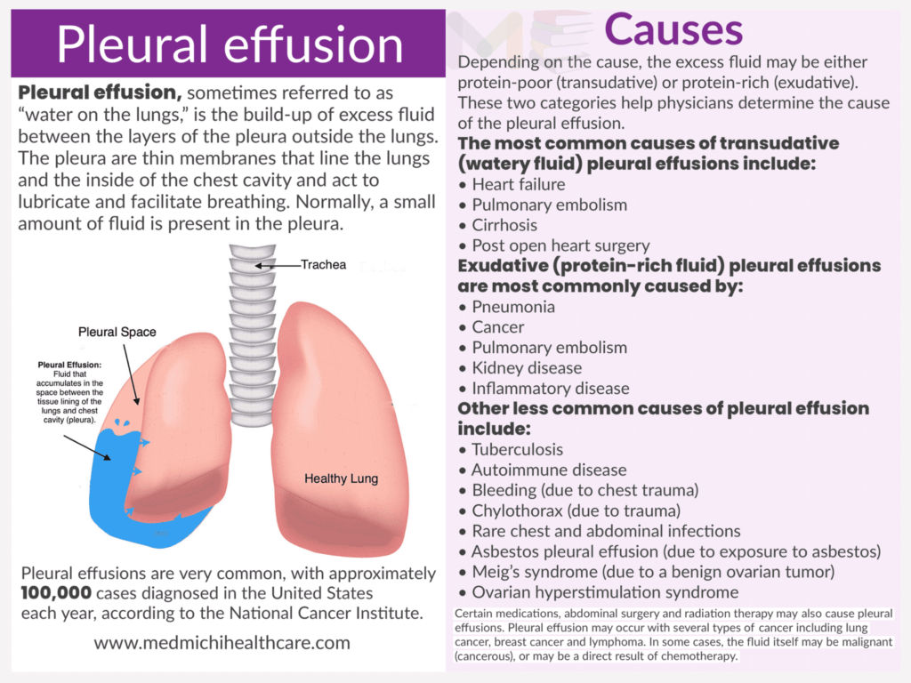 Pleural effusion ​