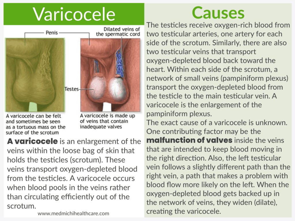 All Disease Causes Short Notes 39 Varicocele 