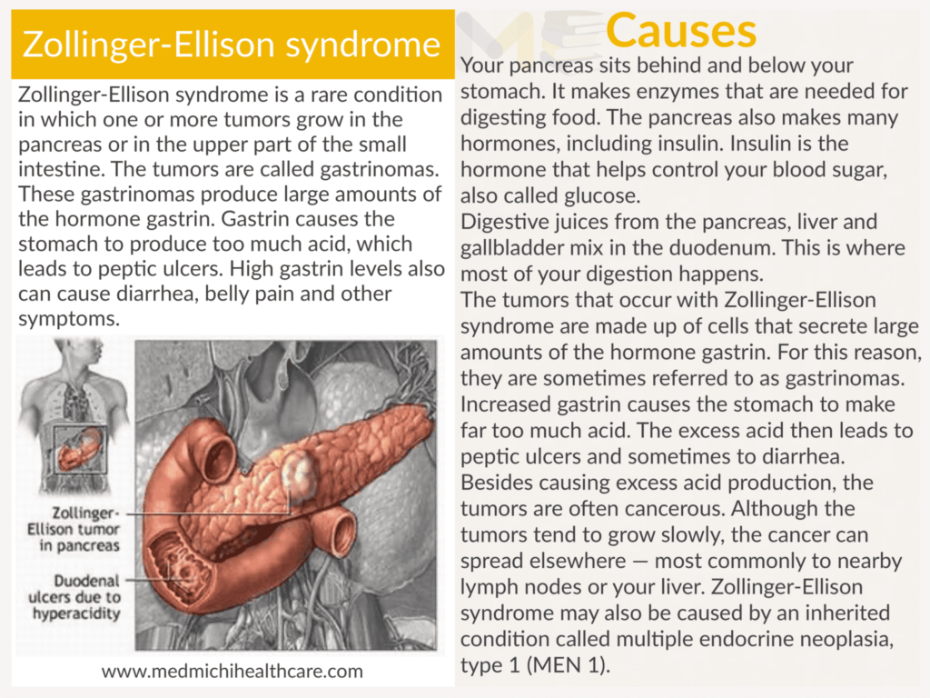 Zollinger ellison syndrome ​