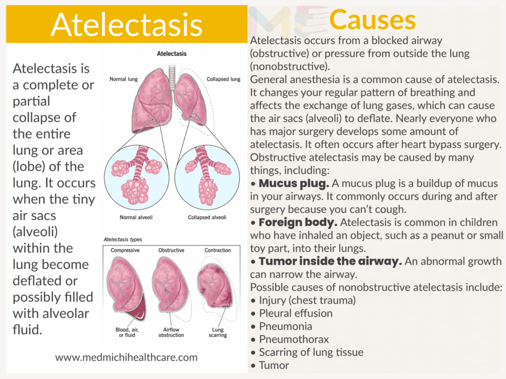 Atelectasis​