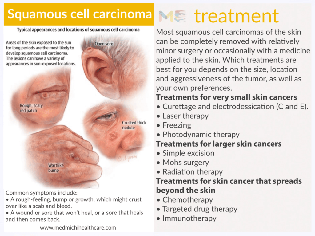 Squamous cell carcinoma 