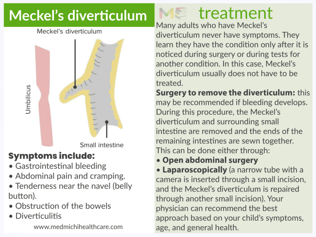 Meckel’s diverticulum 