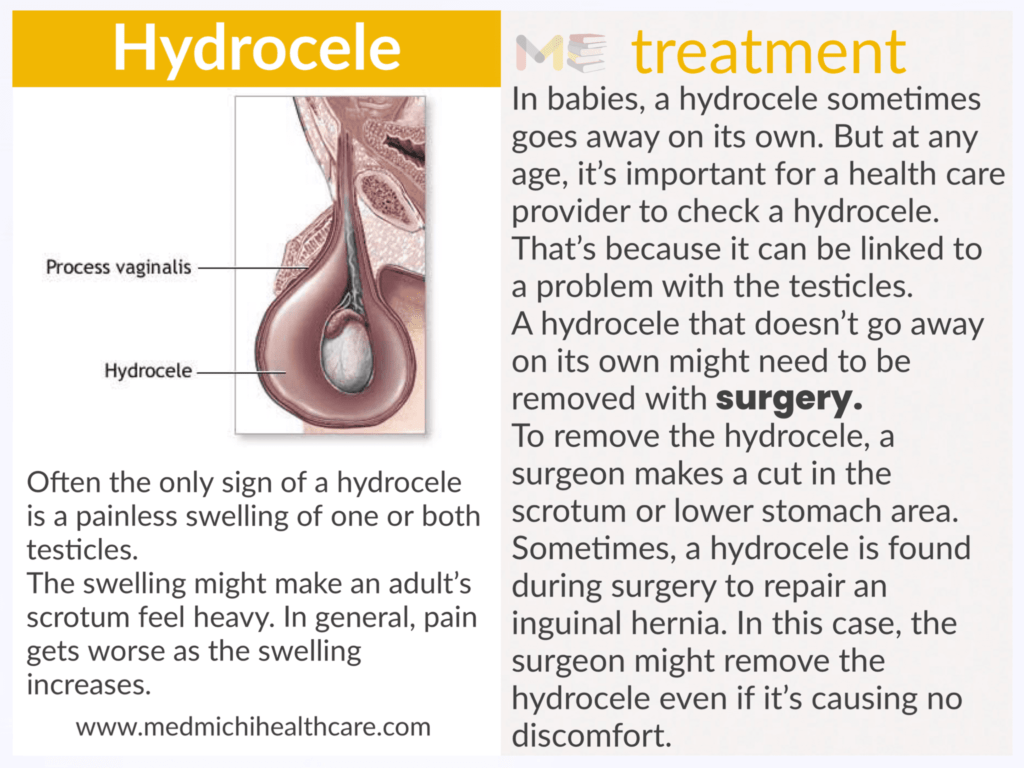 Hydrocele 