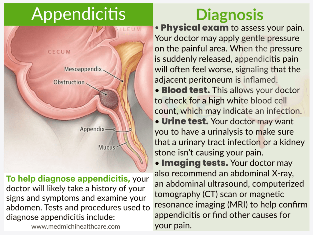 All Disease Diagnosis Short Notes 4 Appendicitis