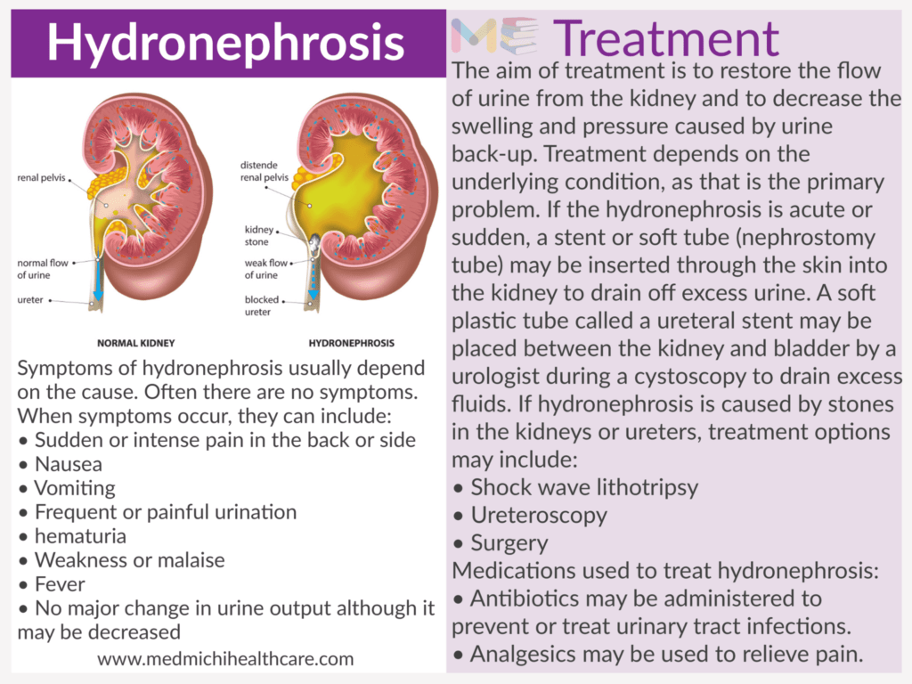 Hydronephrosis​