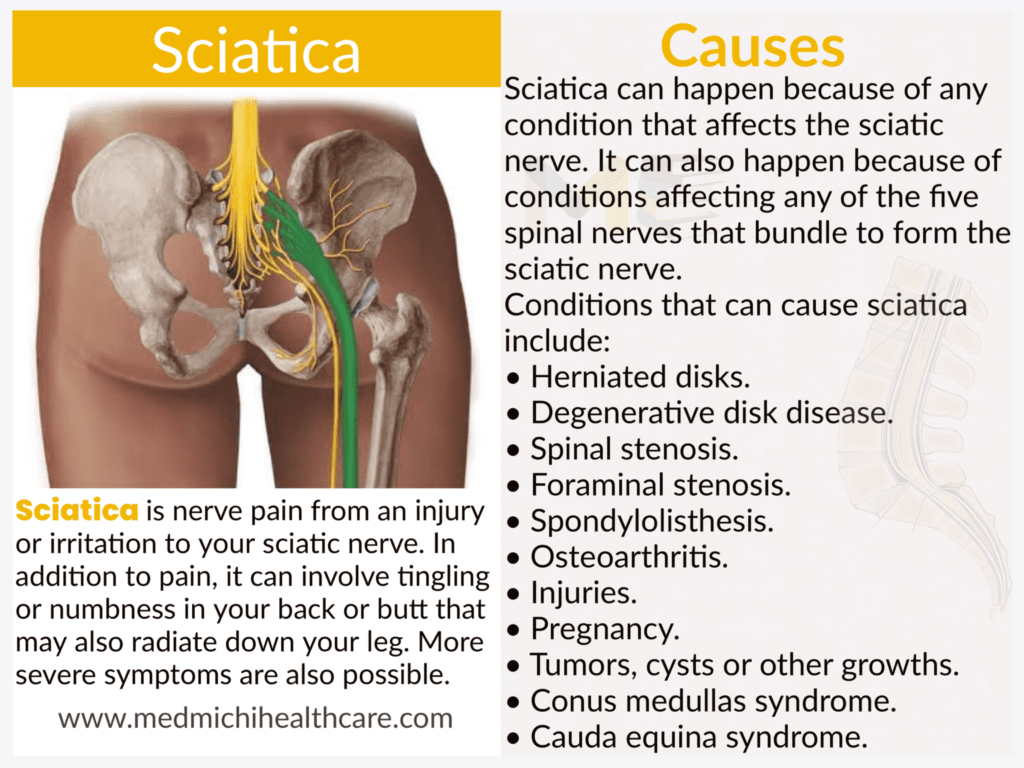 All Disease Causes Short Notes 23 Sciatica