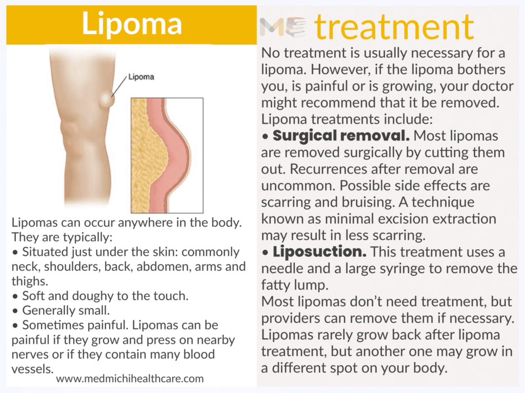 Lipoma 