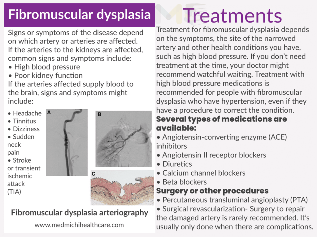 Fibromuscular ​dysplasia