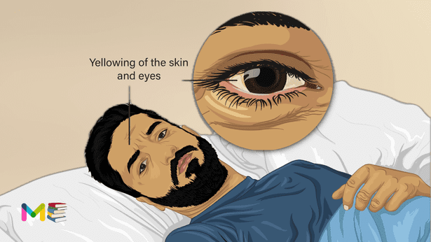 Jaundice