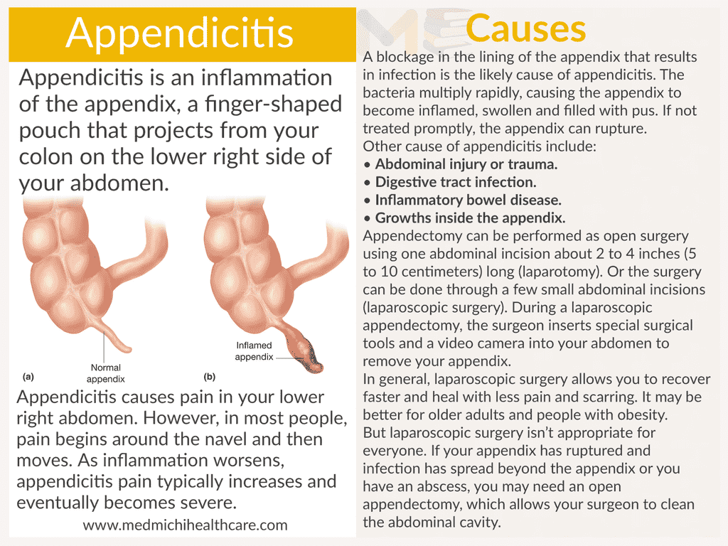 Appendicitis 
