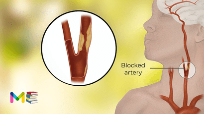 Stroke