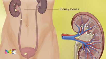 Kidney stones