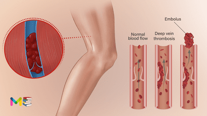 Deep vein thrombosis