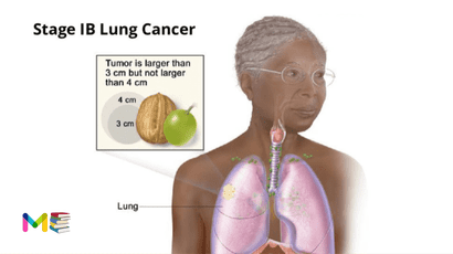 Lung cancer