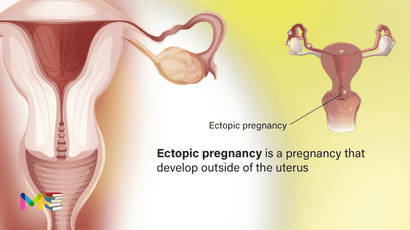 Ectopic pregnancy